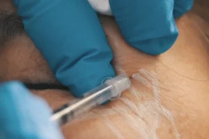 Bótox natural: rejuvenece tu expresión | Dr. Nicolás Heredia