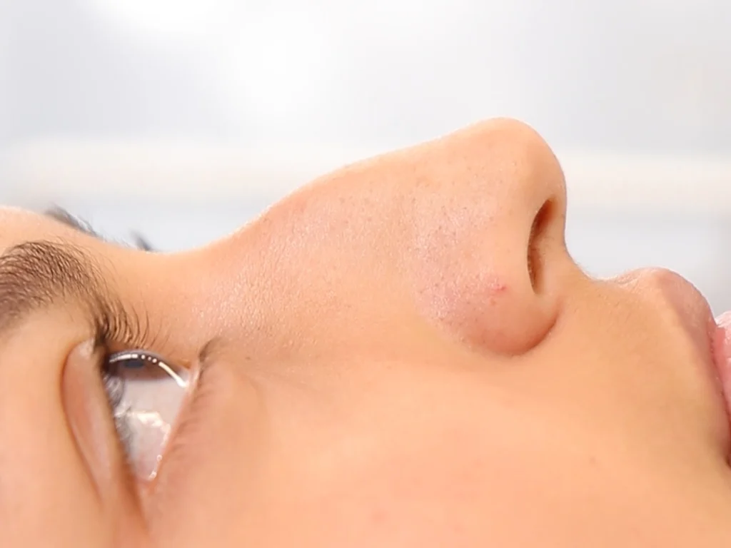 Paciente de rinoplastia ultrasónica con el doctor Nicolás Heredia antes de su tratamiento.